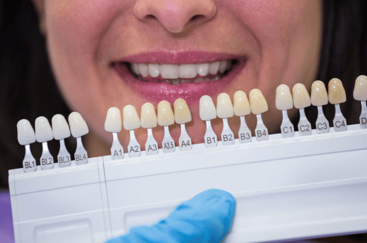 Crowns & Veneers
