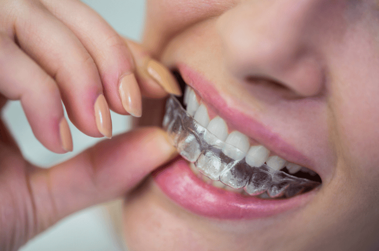 Invisalign & Clear Aligners